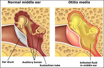 Ear Infections And Treatment