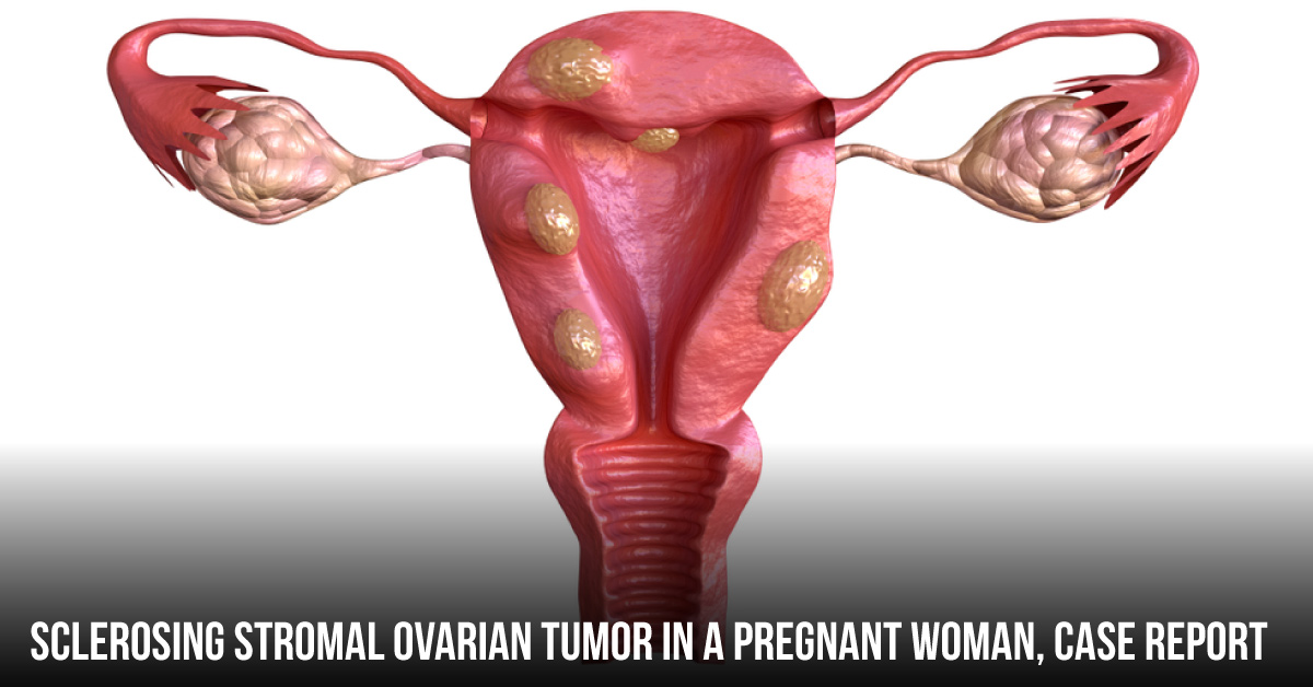 A Rare Case of Sclerosing Stromal Tumor in Pregnancy