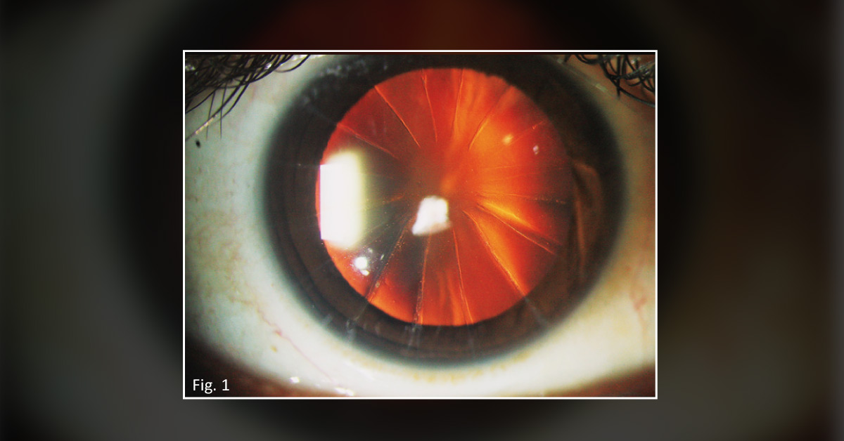 What's Your Diagnosis for This Patient with a Long History of Visual Deterioration?