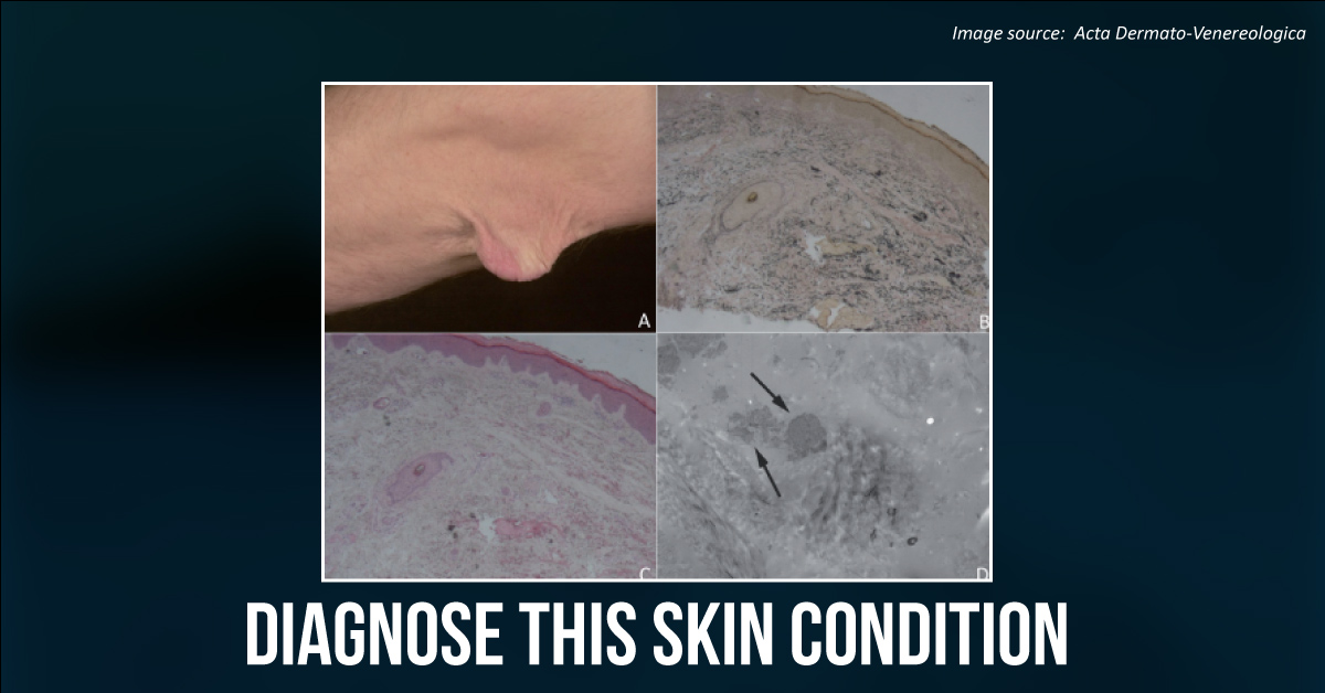 A Patient with Increased Laxity and Hyperesthesia of the Skin on Elbows and Knees