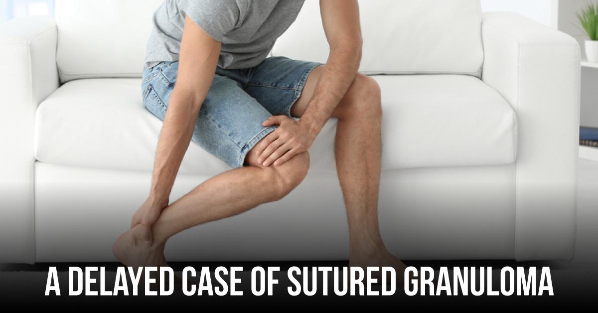 Suture Granuloma: A Complication 30 Years After Open Repair of Achilles Tendon Rupture