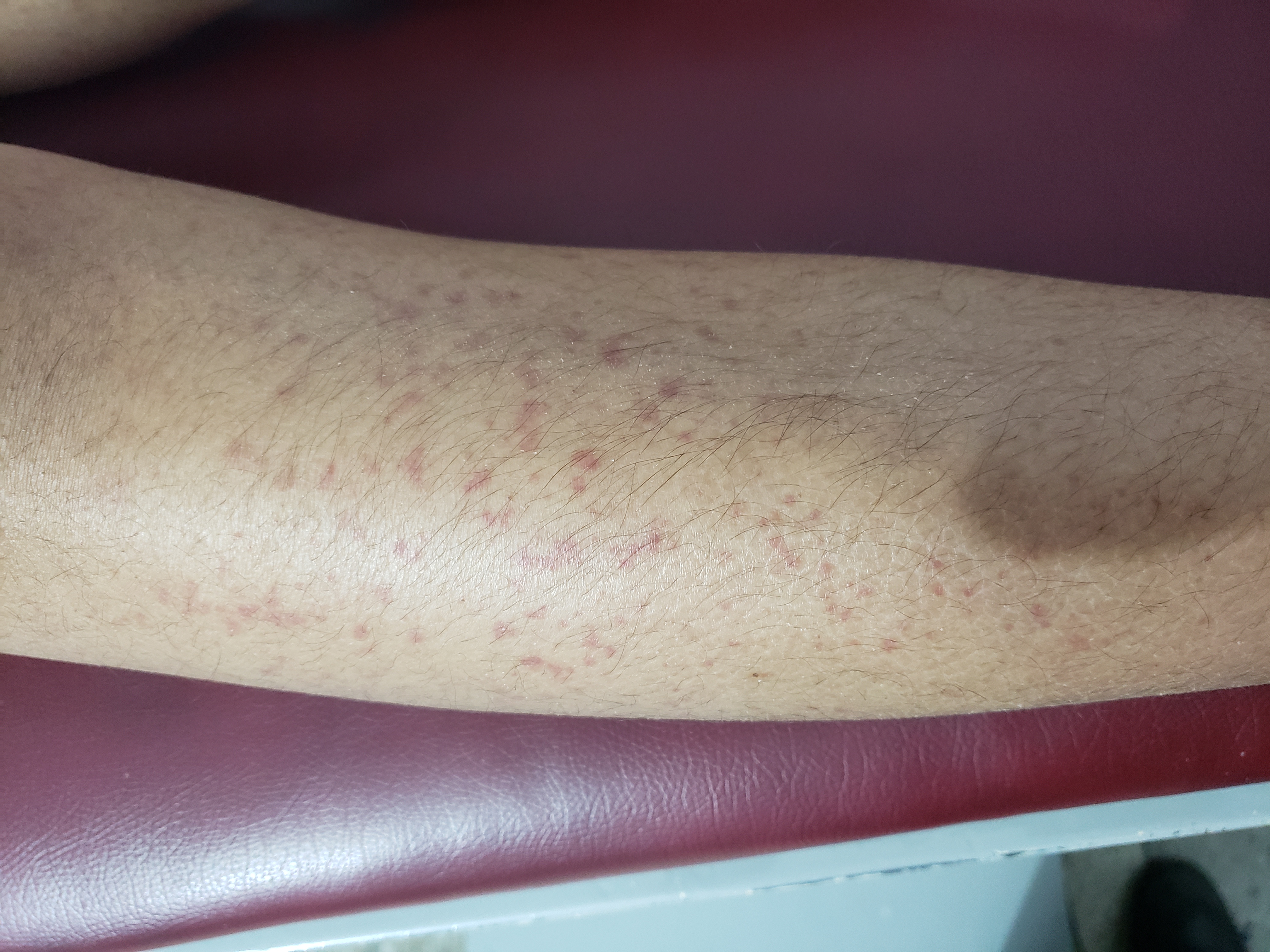 Urticarial Rash In Child, Requires Diagnosis?