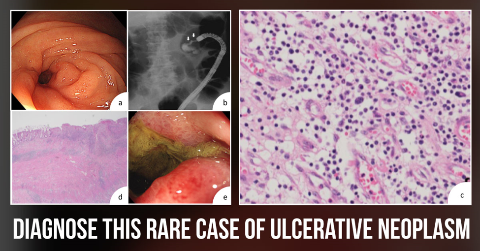 Diagnose This Ulcerative Complex Condition