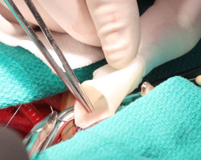 Yarn Made From Human Tissue Being Used For Repair In Human