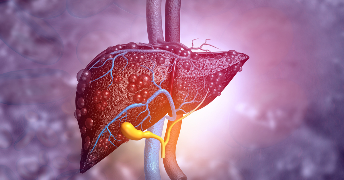 Fatty Liver Disease In Patients With Diabetes