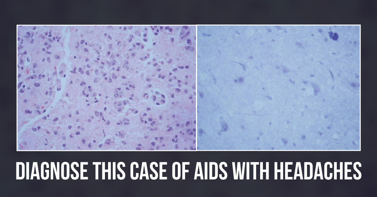 This Patient with AIDS is Suffering from Persistent Headaches