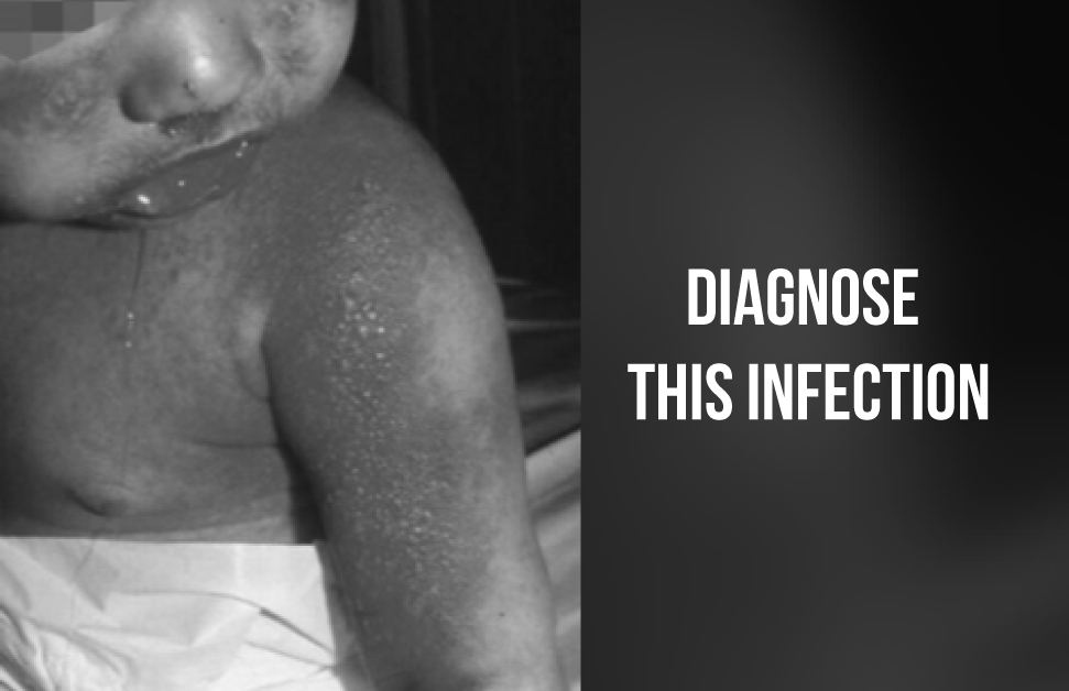 Ritter’s Disease: A Potential Life-threatening Disease