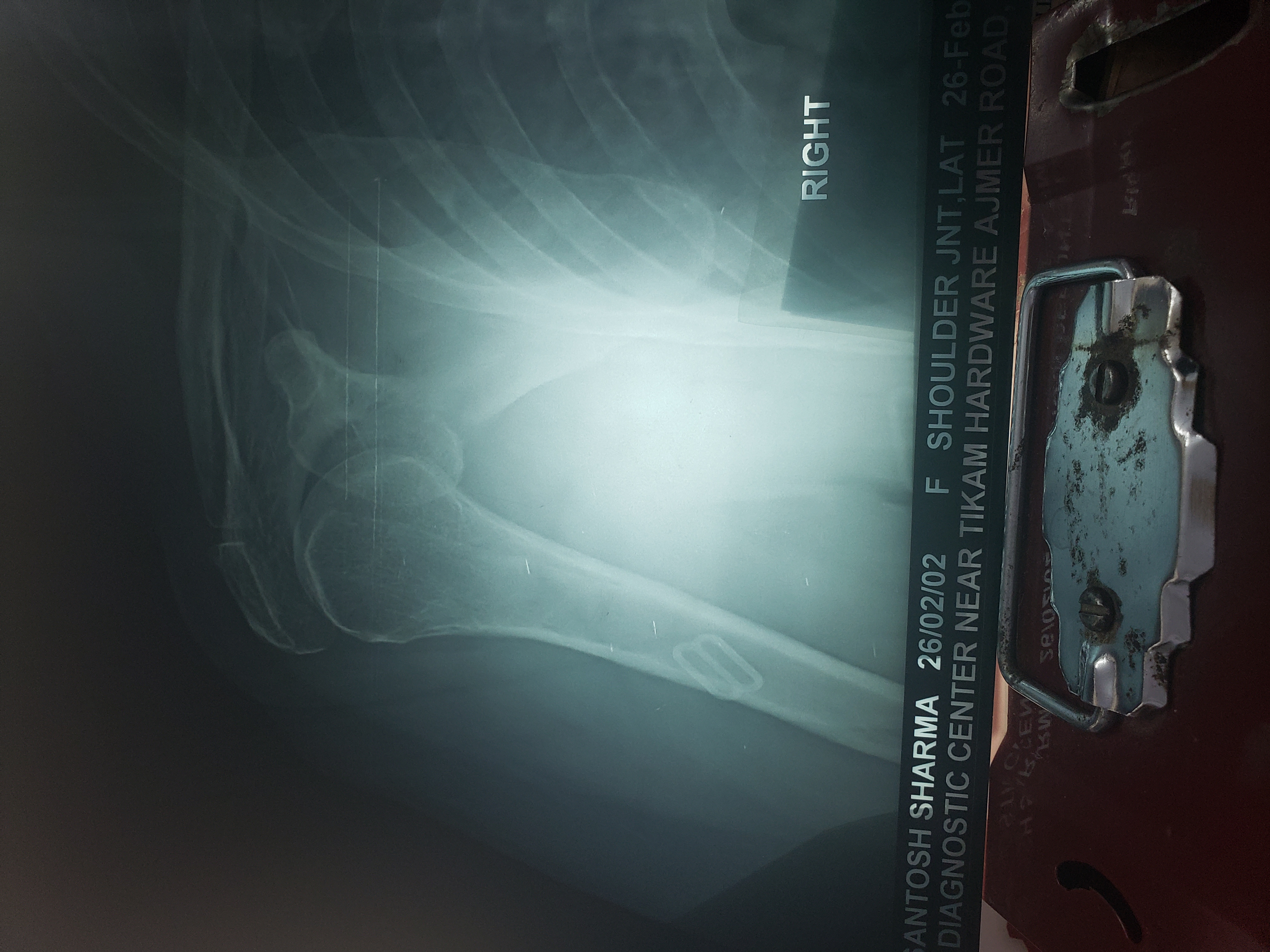 Is There Any Fracture In Rt Shoulder Joint?