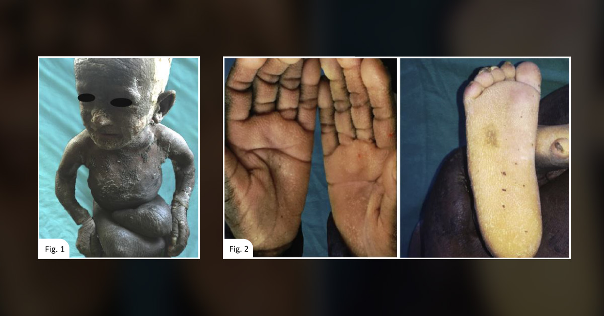 Case of A Rare Multi-System Disorder