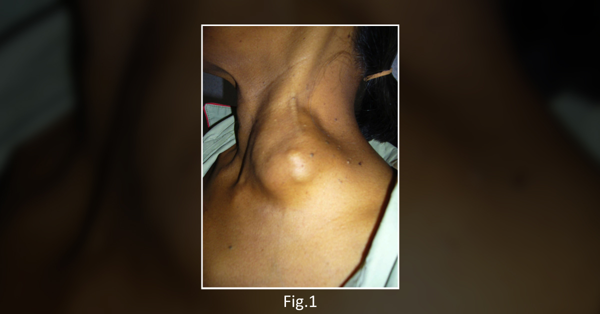 An Unusual Case of Enlarging Neck Mass