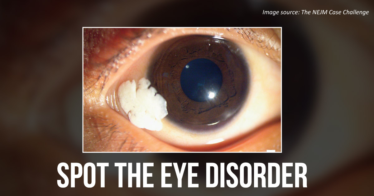 Case of a Rare Ophthalmic Presentation in a Child