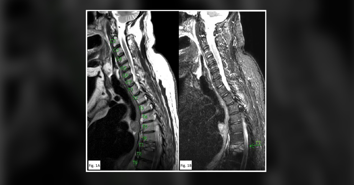 Dexmedetomidine for an Opioid-tolerant Patient: A Case Report