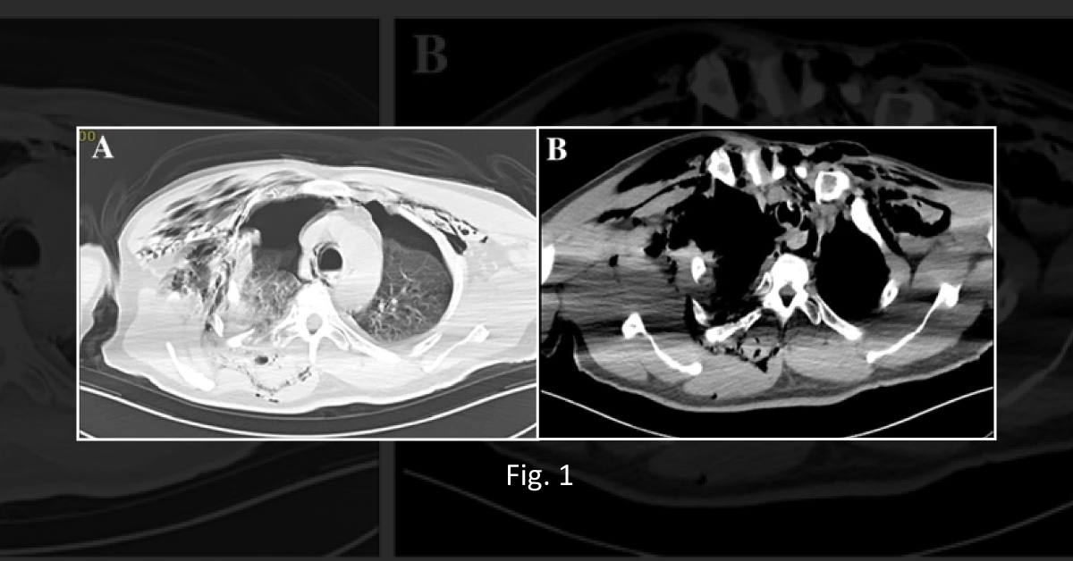 A Case of Traumatic Tracheobronchial Lacerations and Anesthetic Management