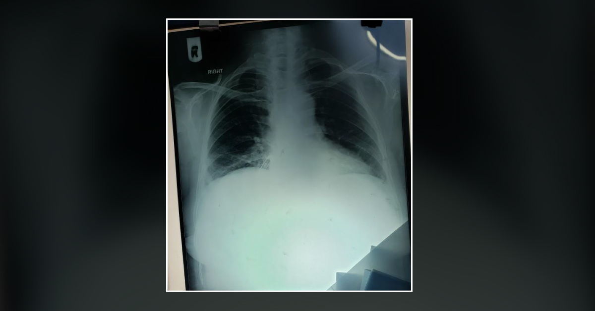 Are These Lesions Are Rheumatoid Nodules In Rt Lower Lobe?