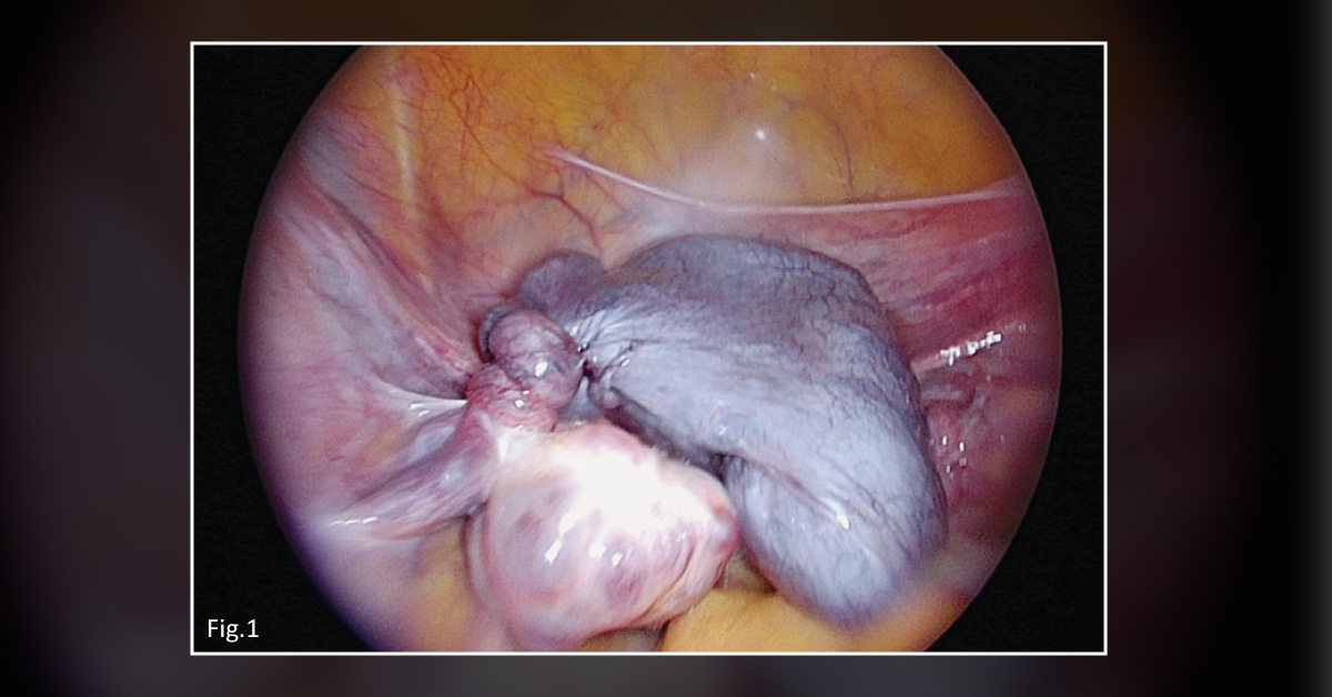 A Case of Sudden Abdominal Pain in a Young Patient