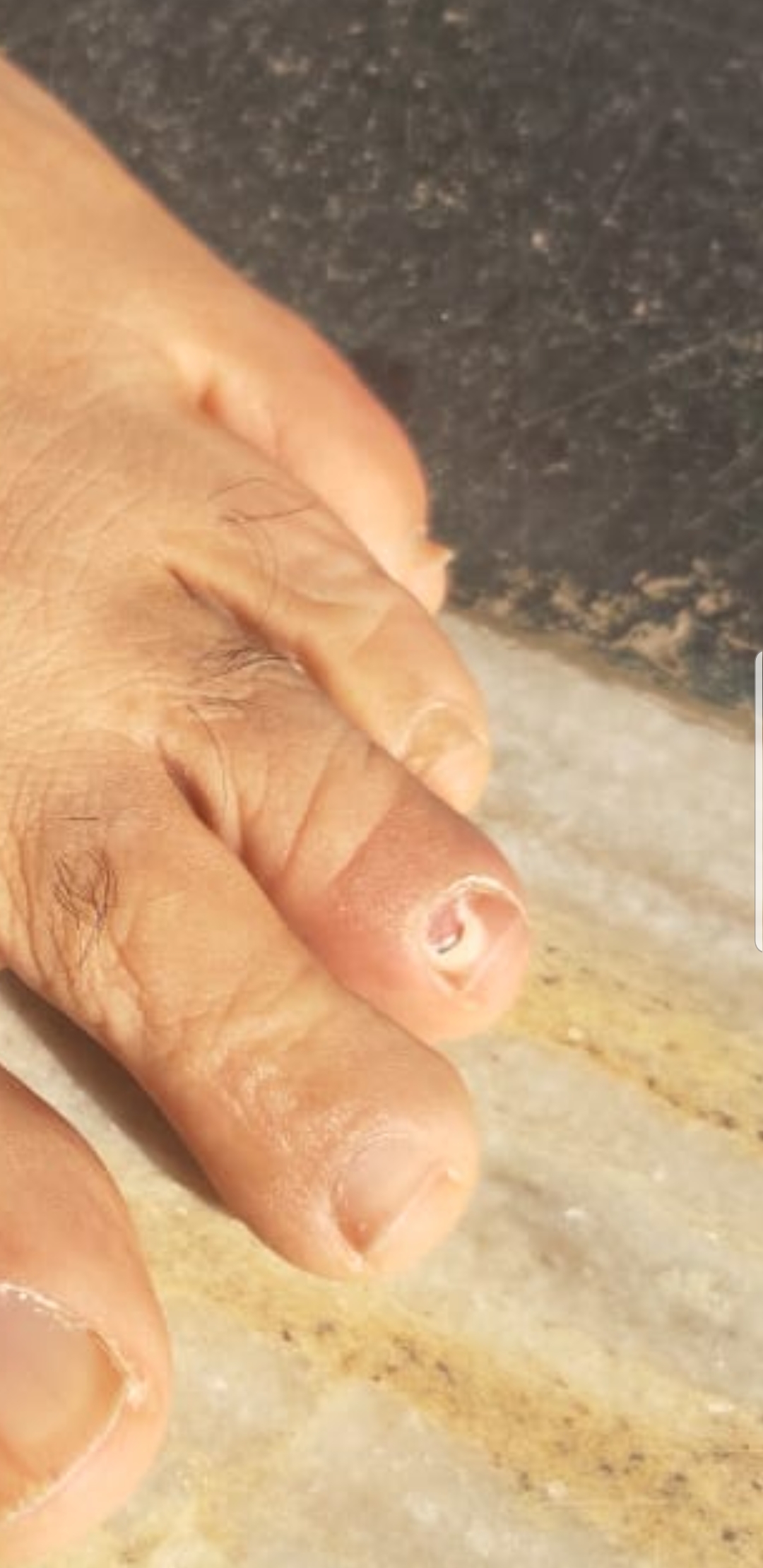 What Is This Nail Lesion?
