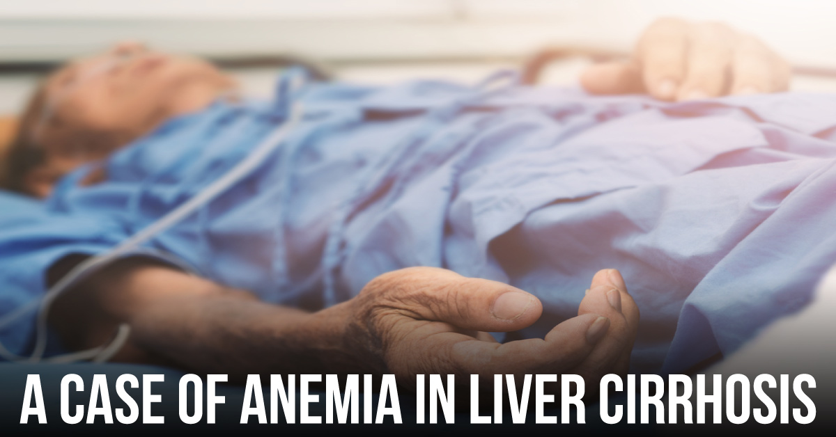 Gall Bladder Perforation in Liver Cirrhosis and Ascites: A Case Report