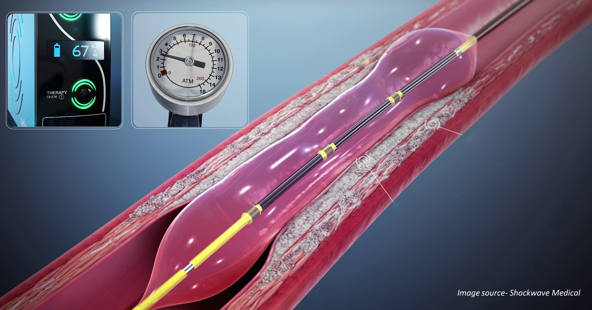 Novel Balloon Treatment For Heart Patients Invented