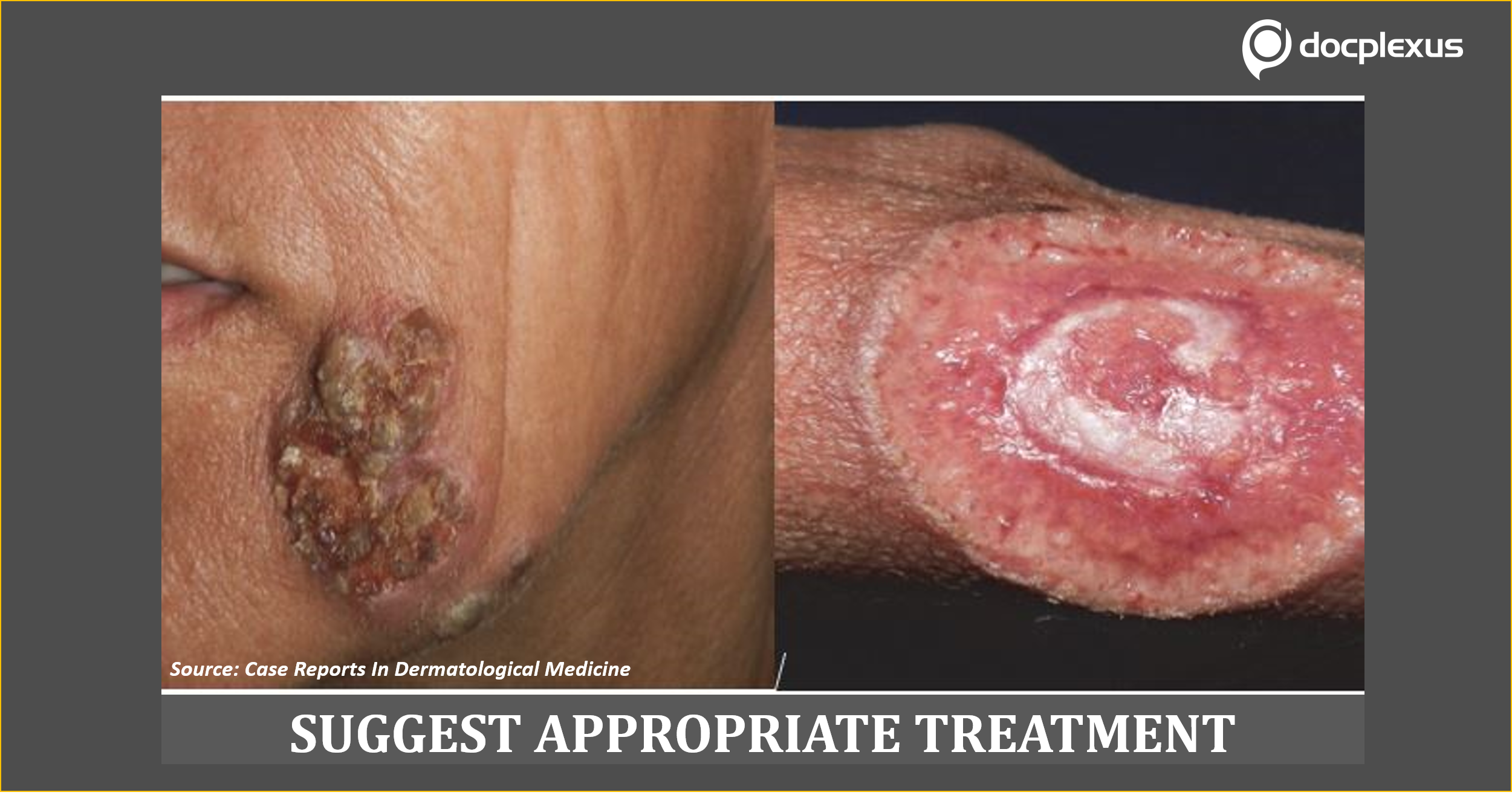 Suggest the Most Appropriate Therapy for This HIV-positive Patient with Syphilis