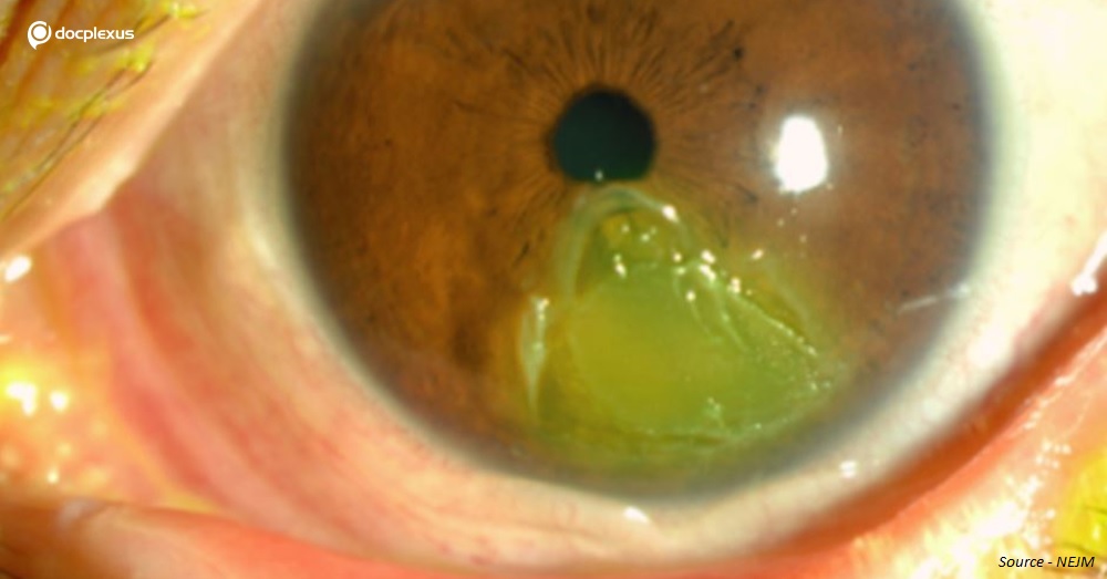 What Could be the Reason Behind This Corneal Damage?