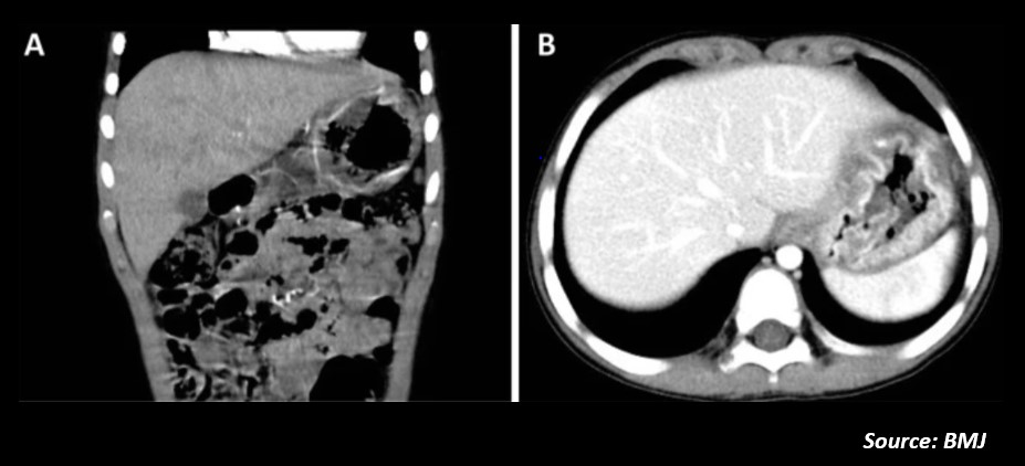 What is Your Diagnosis for This Young Boy with Abdominal Pain and Eyelid Edema?
