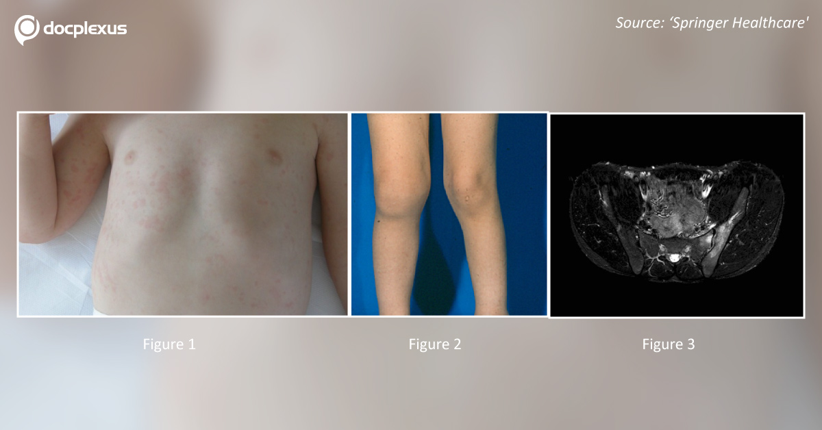 Juvenile Idiopathic Arthritis