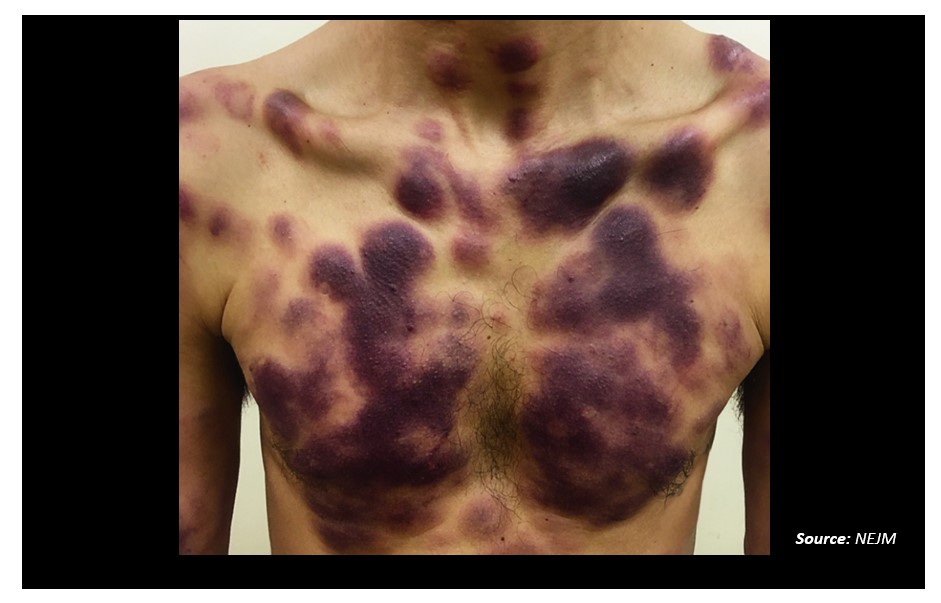 Diagnose The Condition Of A Man Based On The Given Image.