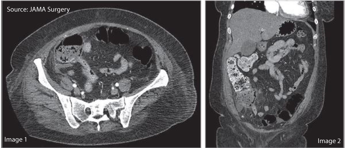 Diagnose The Cause Of Right Lower Quadrant Pain In An Old Patient