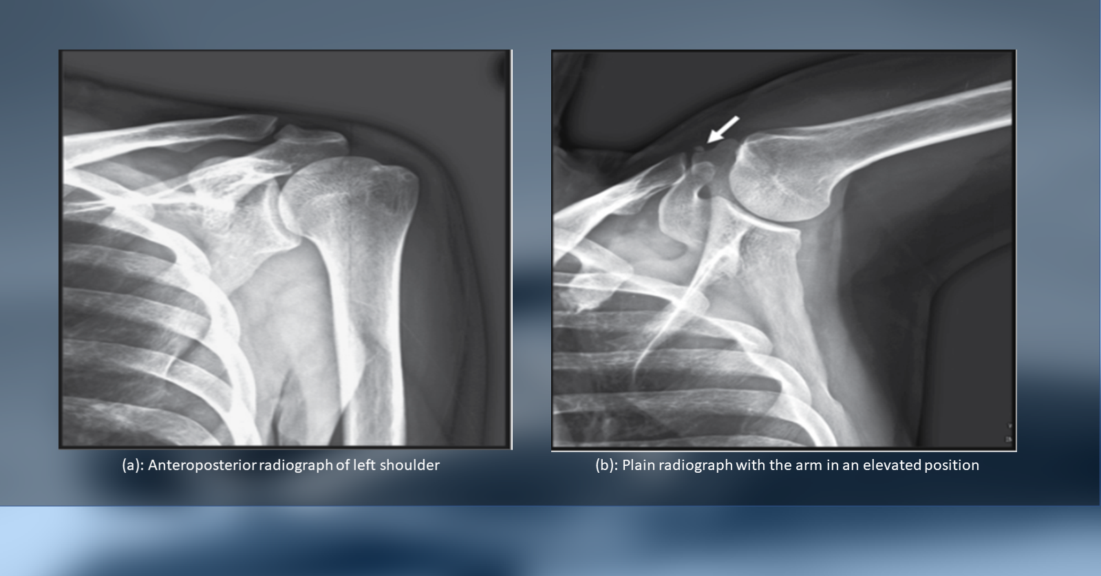 Diagnose the Cause of Sudden Pain in the Left Shoulder in this 45-year-old Man