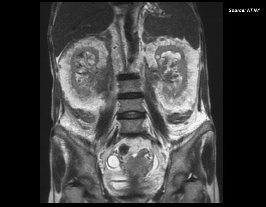 Dyspnea and Generalized Weakness in a Woman with a History of CKD and Myelofibrosis