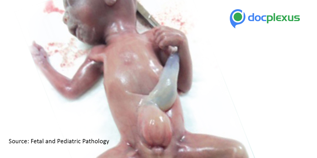 Bladder Exstrophy, A Life-threatening Urologic Condition
