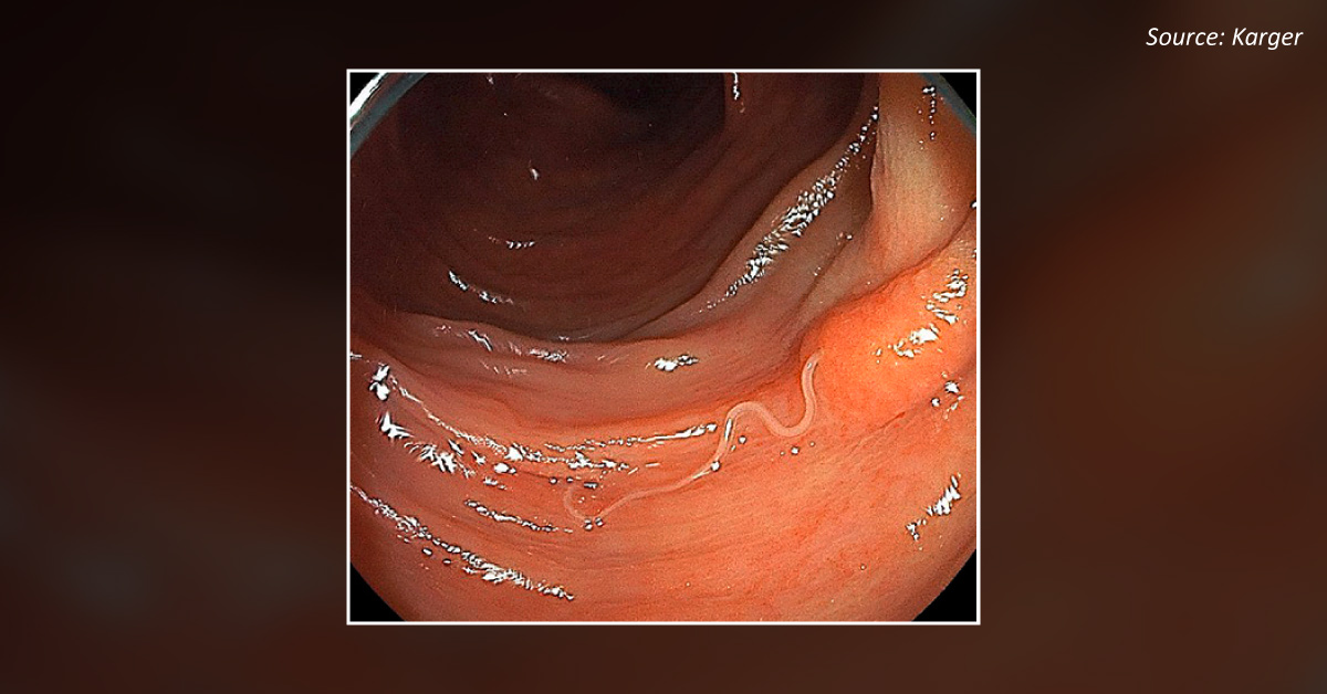 Diagnose The Condition With The Help Of Colonoscopy Results