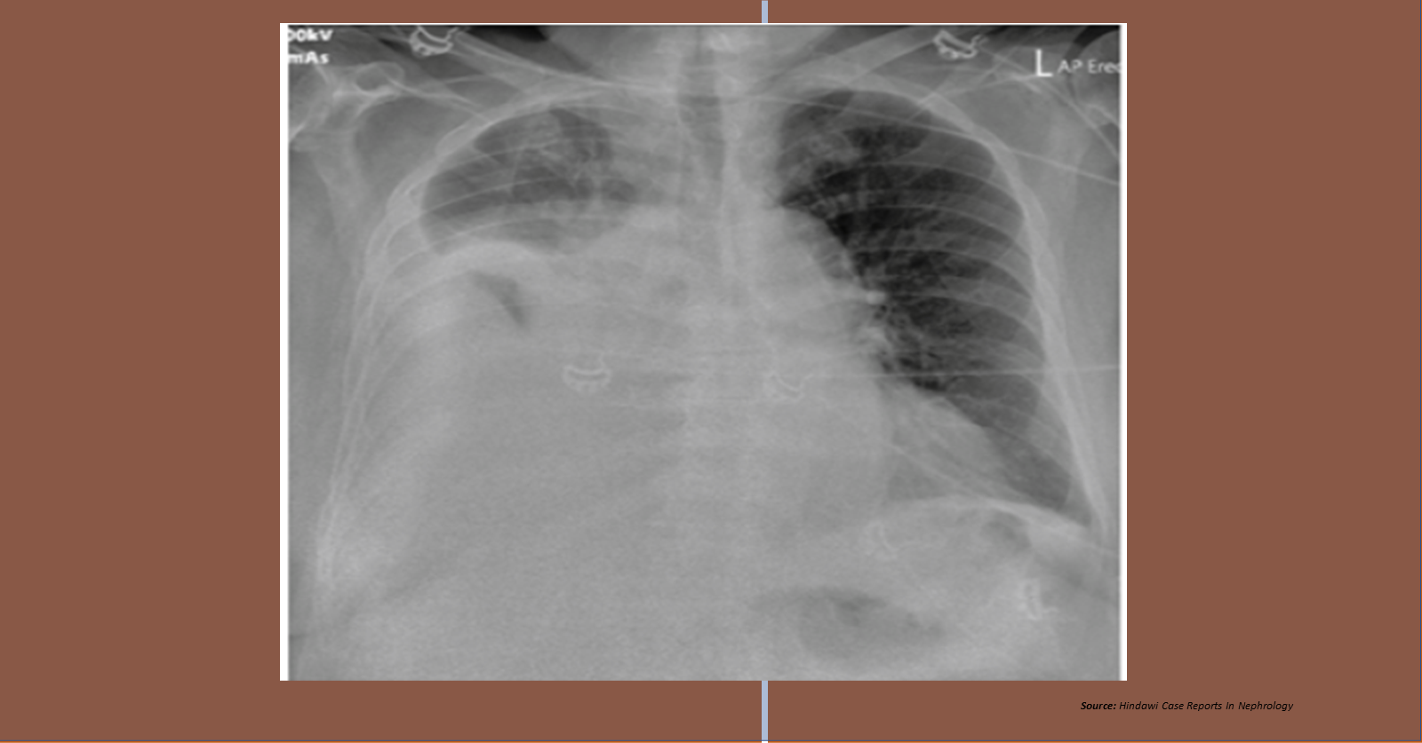 Diagnose This Case of Peritoneal Dialysis