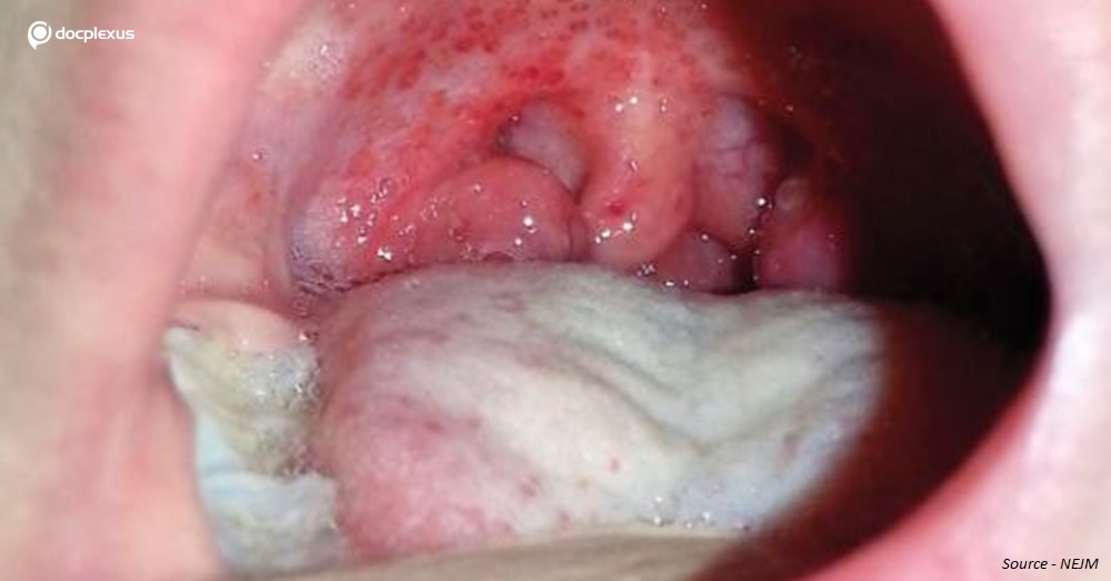 Can You Identify the Reason Behind Oral Lesions in This Young Girl?