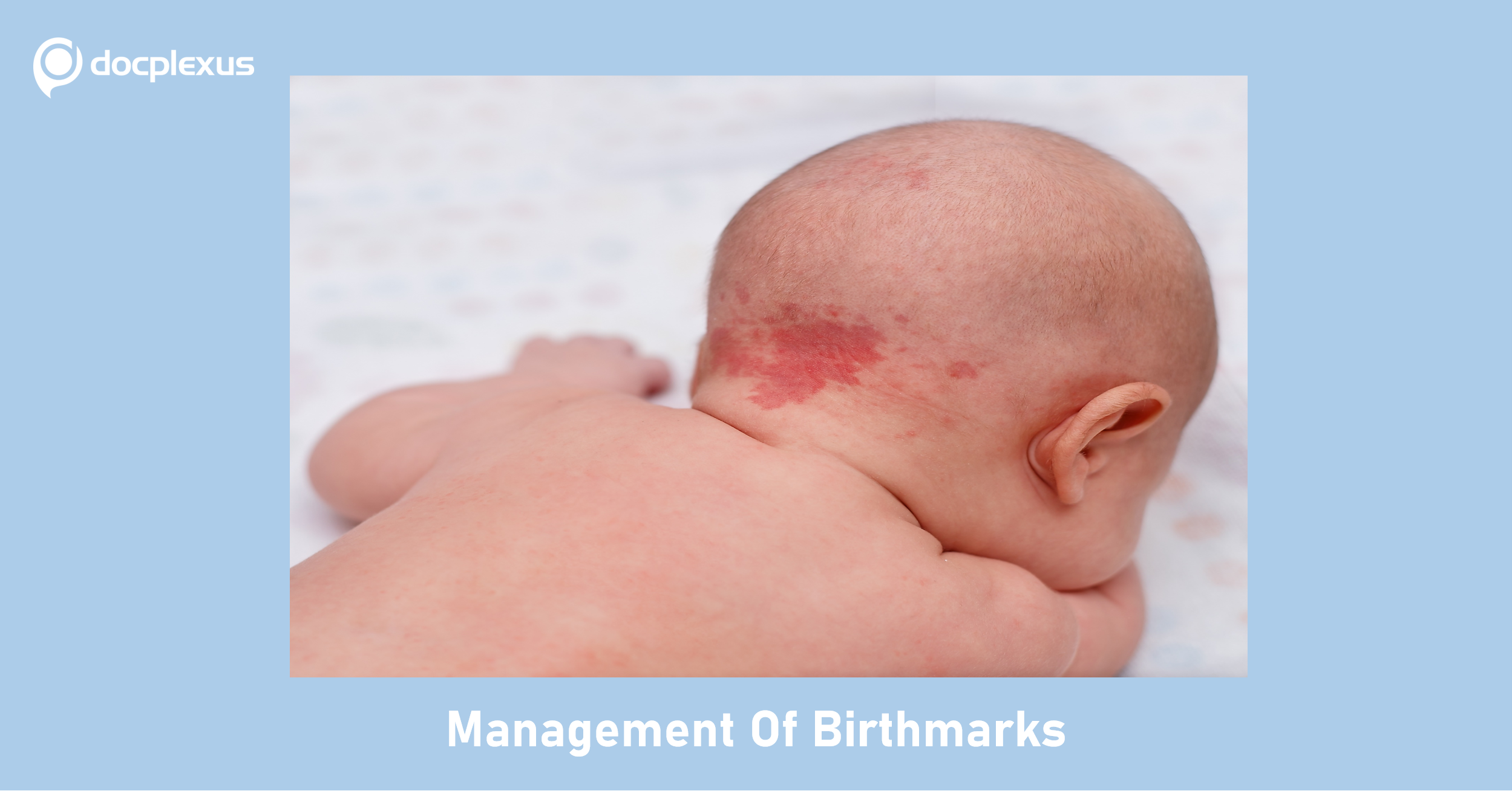 Birthmarks: Treatment and Management