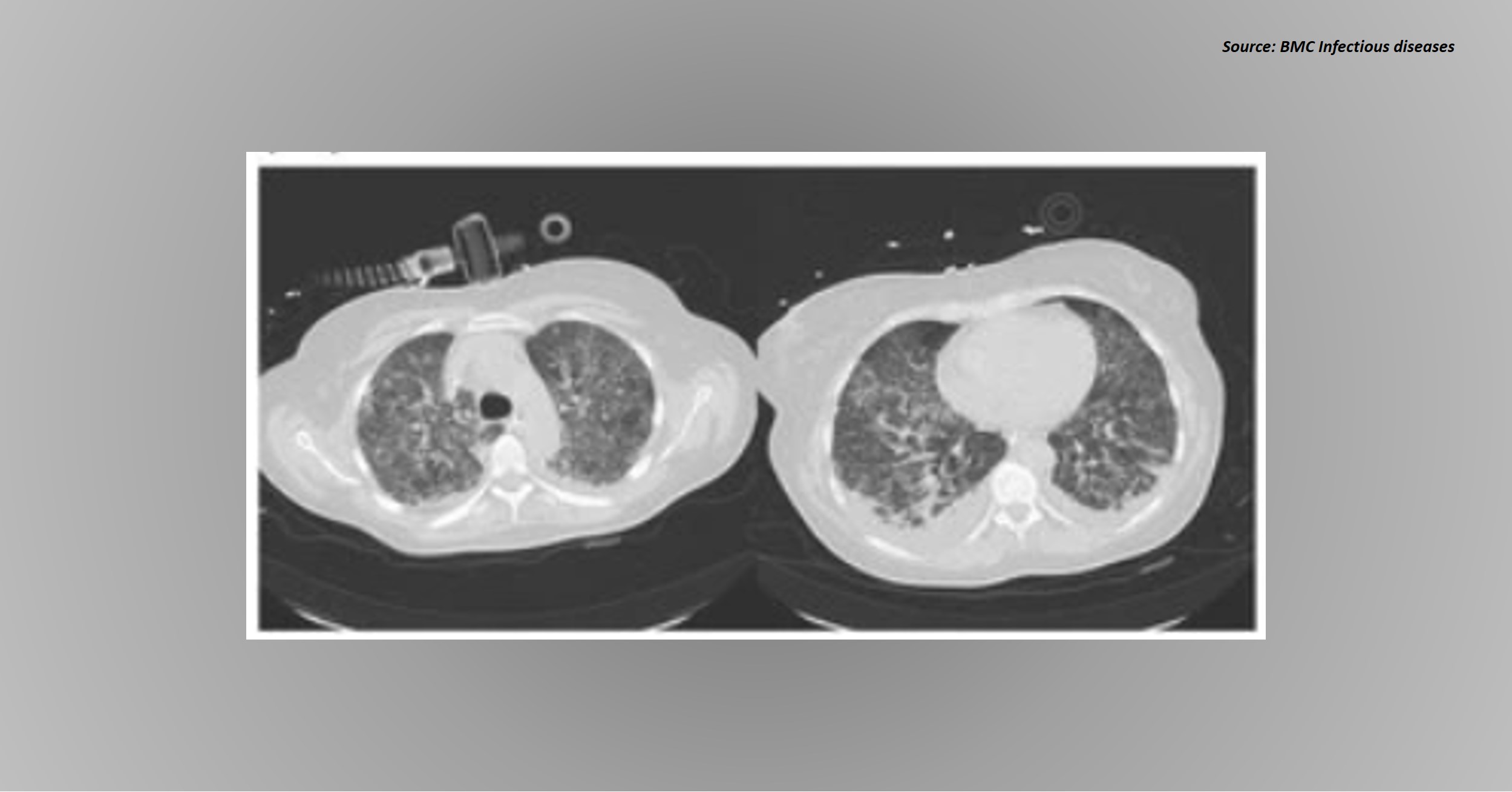 A Case of Gardening-induced Pulmonary Failure