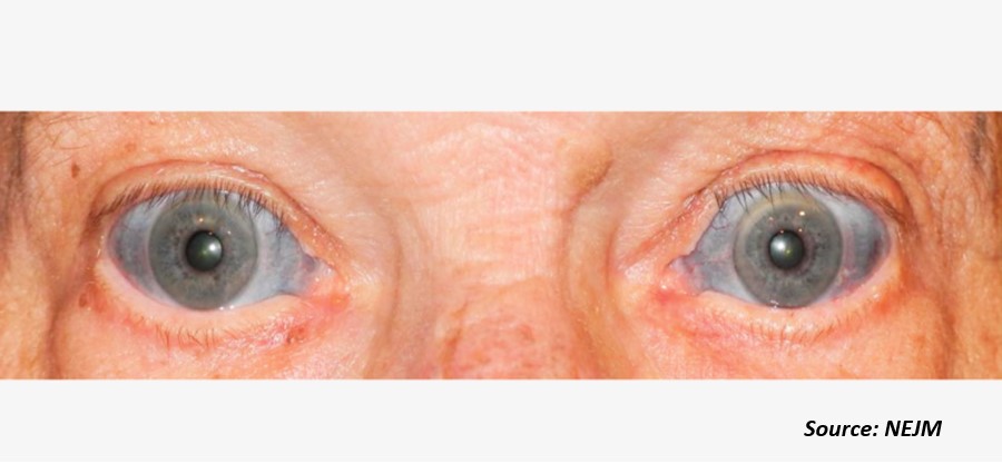 Diagnose The Case of a Man with Blue Eyes