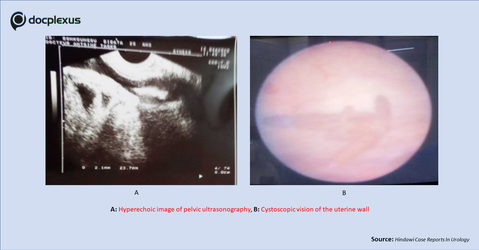 A Rare Case of Irritations in the Lower Urinary Tract