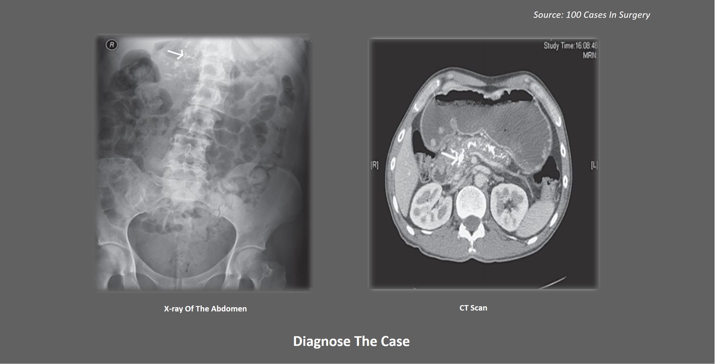 Diagnose This Patient With Chronic Epigastric Pain