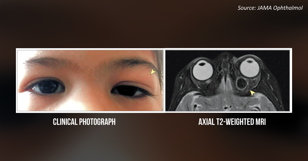 Case of a Child with Acute Eyelid Edema and Proptosis