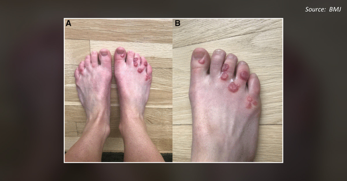 A Woman with Cutaneous Lesions