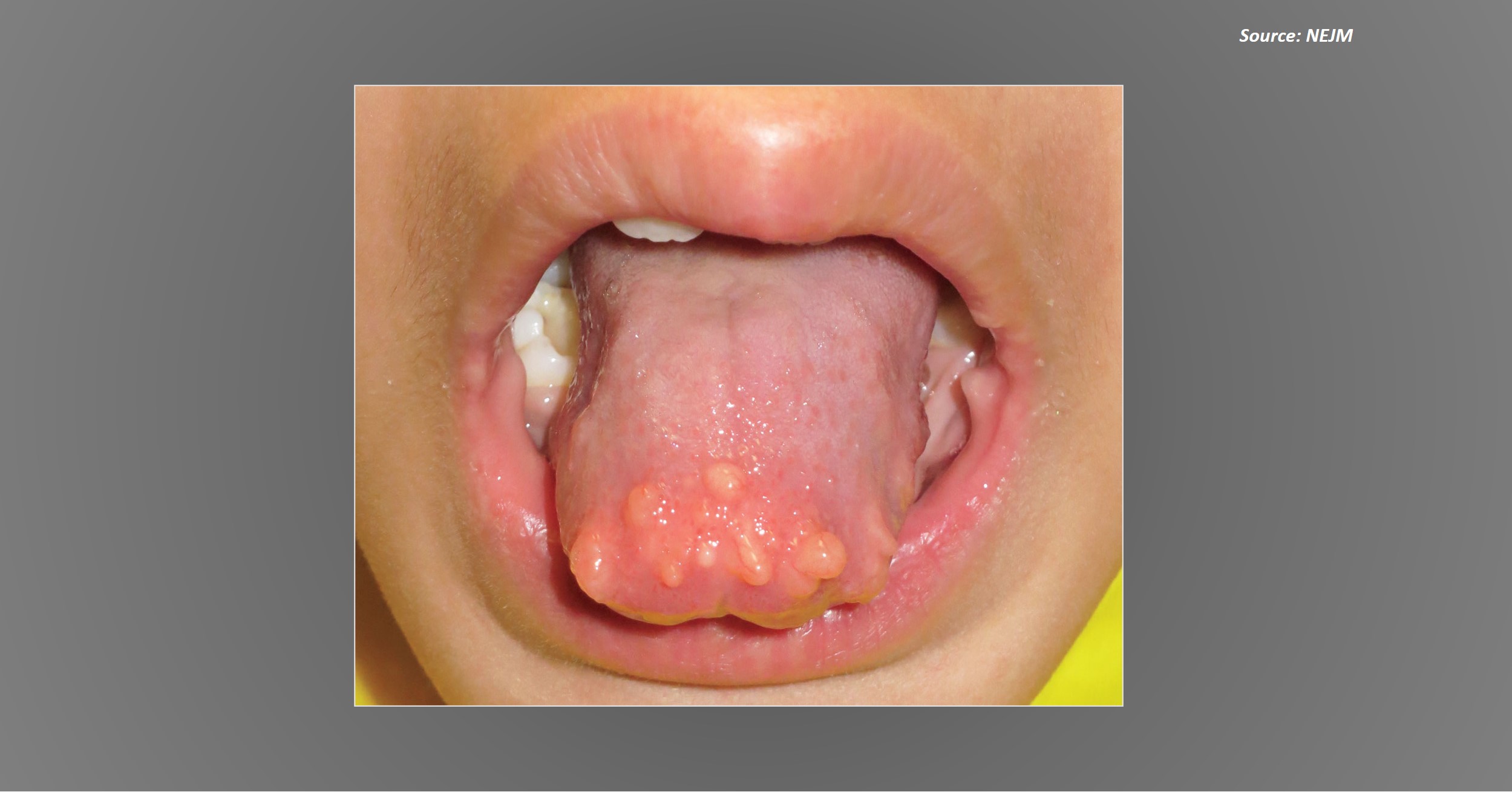 A Case of Multiple Tongue Nodules