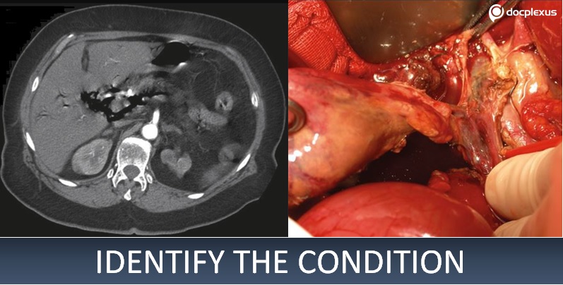 An Old Woman with Severe Abdominal Pain