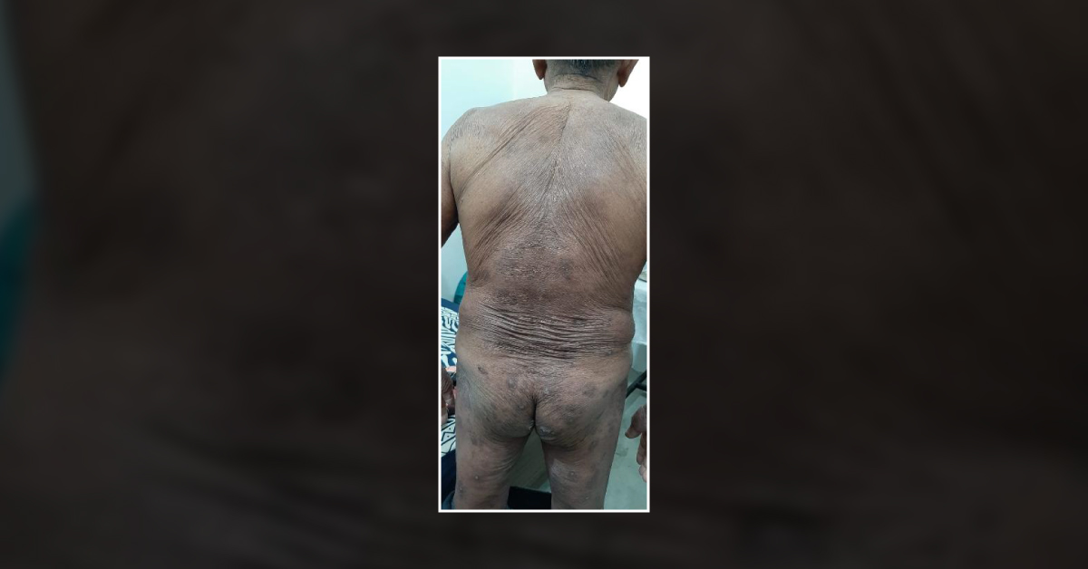 80 Years Old Male Patient With Comorbidities