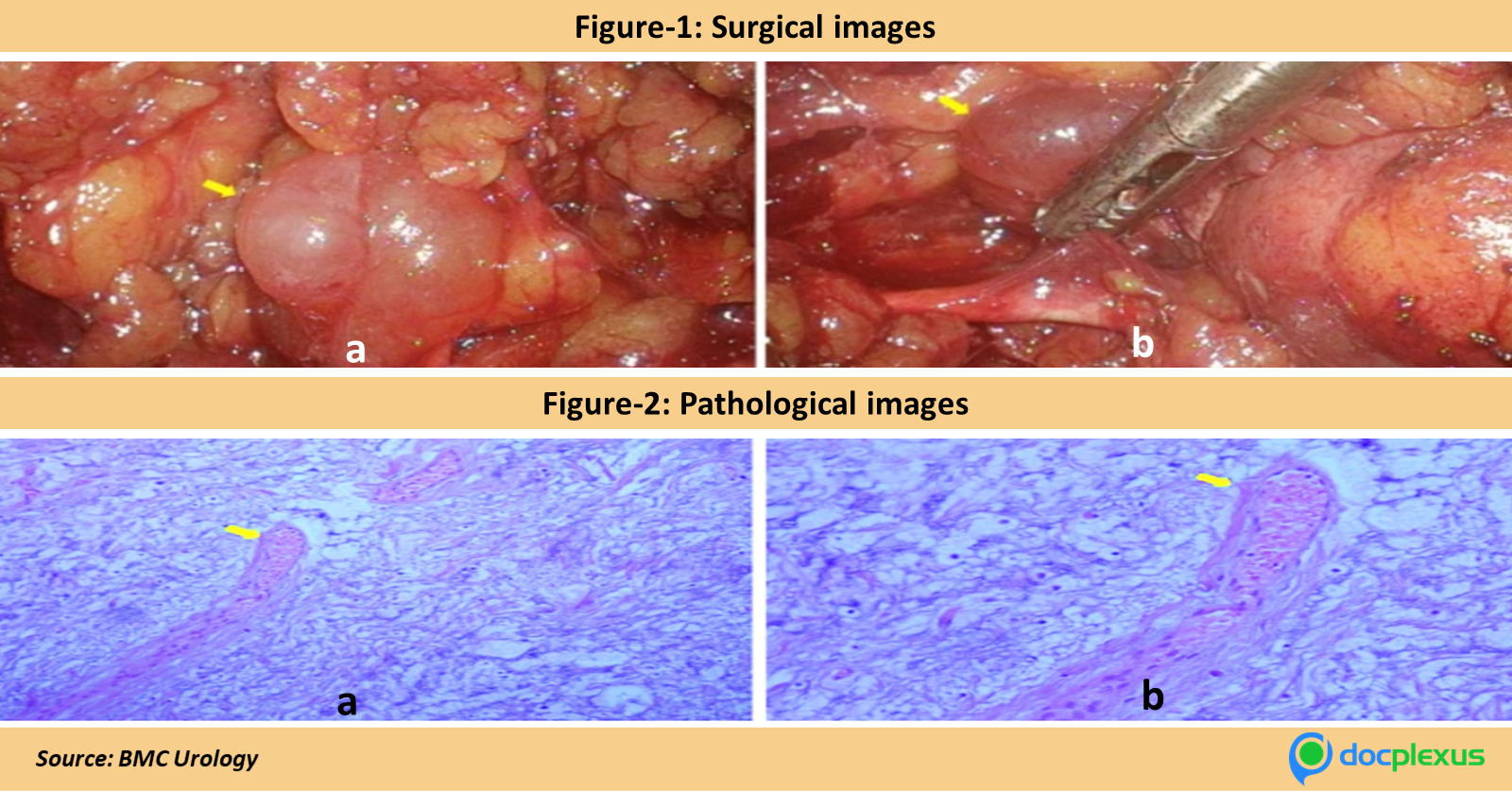 Can You Identify This Rare Para-ureteral Condition?