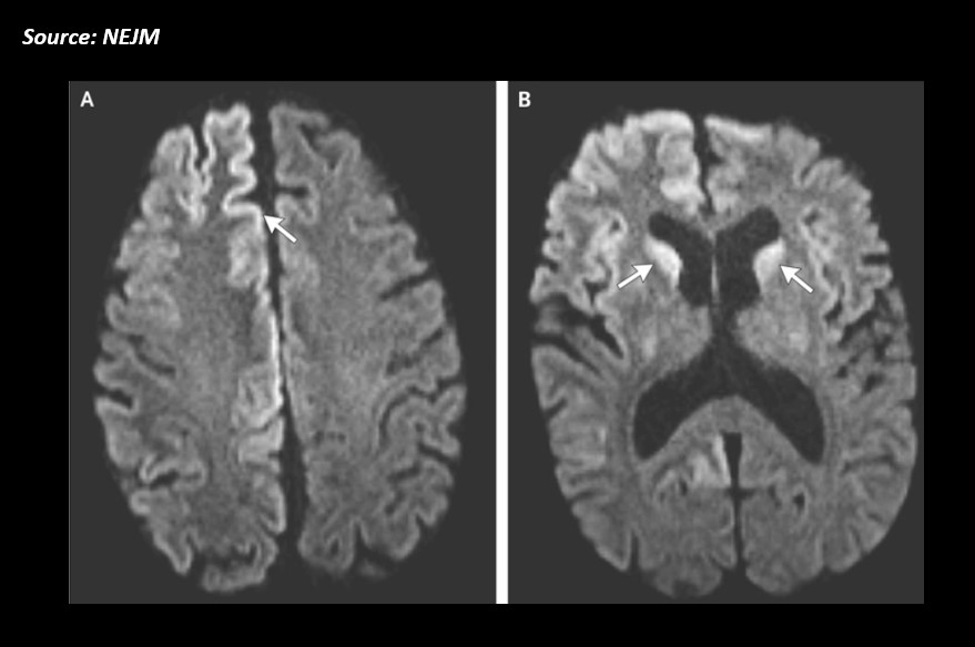 Diagnose the Case of a Man with Cognitive Deterioration
