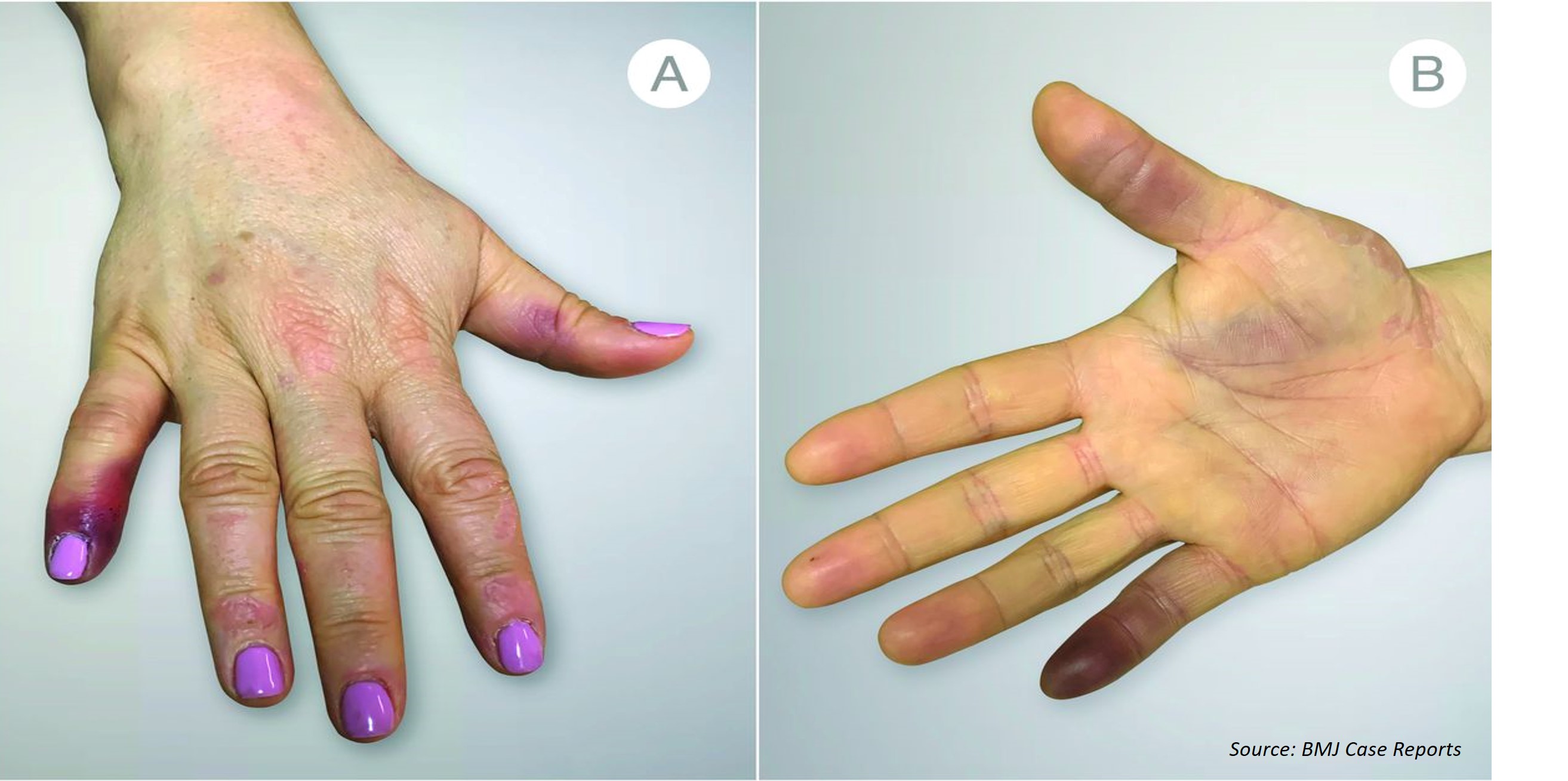 A Case of a Self-limiting Finger and Palmar Hematoma