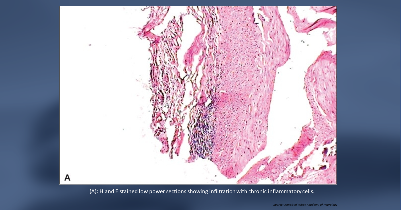 Diagnose the Cause of Right Hemicrania Continua in an Old Patient