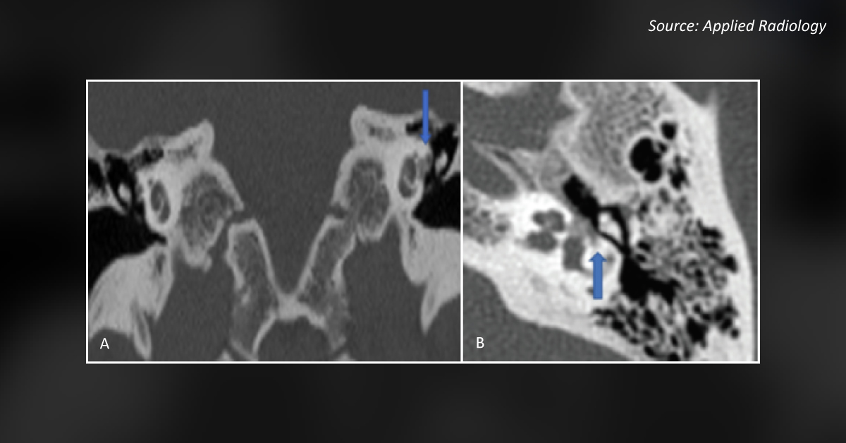 Decode the Case of Progressive Hearing Loss and Tinnitus