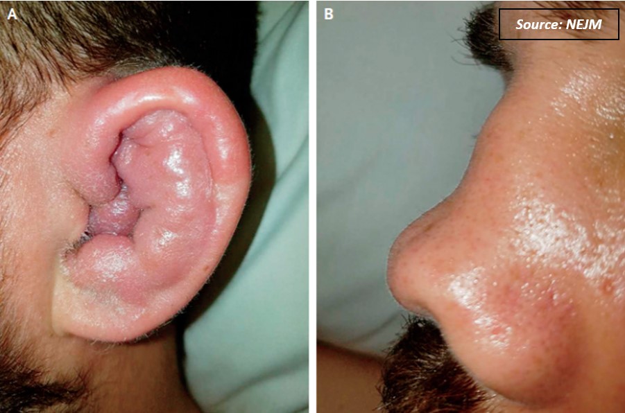 Case of a Man with a Swollen Ear  – What's Your Diagnosis?